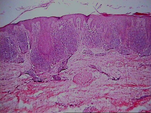Fig.2 Aspecto de dermat. liquenoide psoriasiforme - <div style=